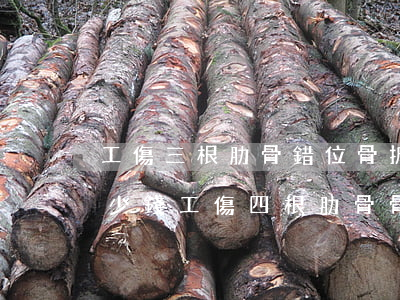 工傷三根肋骨錯位骨折應(yīng)賠多少錢?(工傷四根肋骨骨折私了賠幾萬)