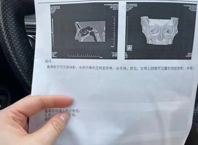 整容手术多少钱一次(整容还是毁容？女子花2万多元矫正鼻子，结果……)