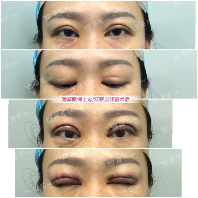 整形失败的专业律师(高知律师眼整形失败10年，直言：“尽管年纪大了，仍然自卑”)